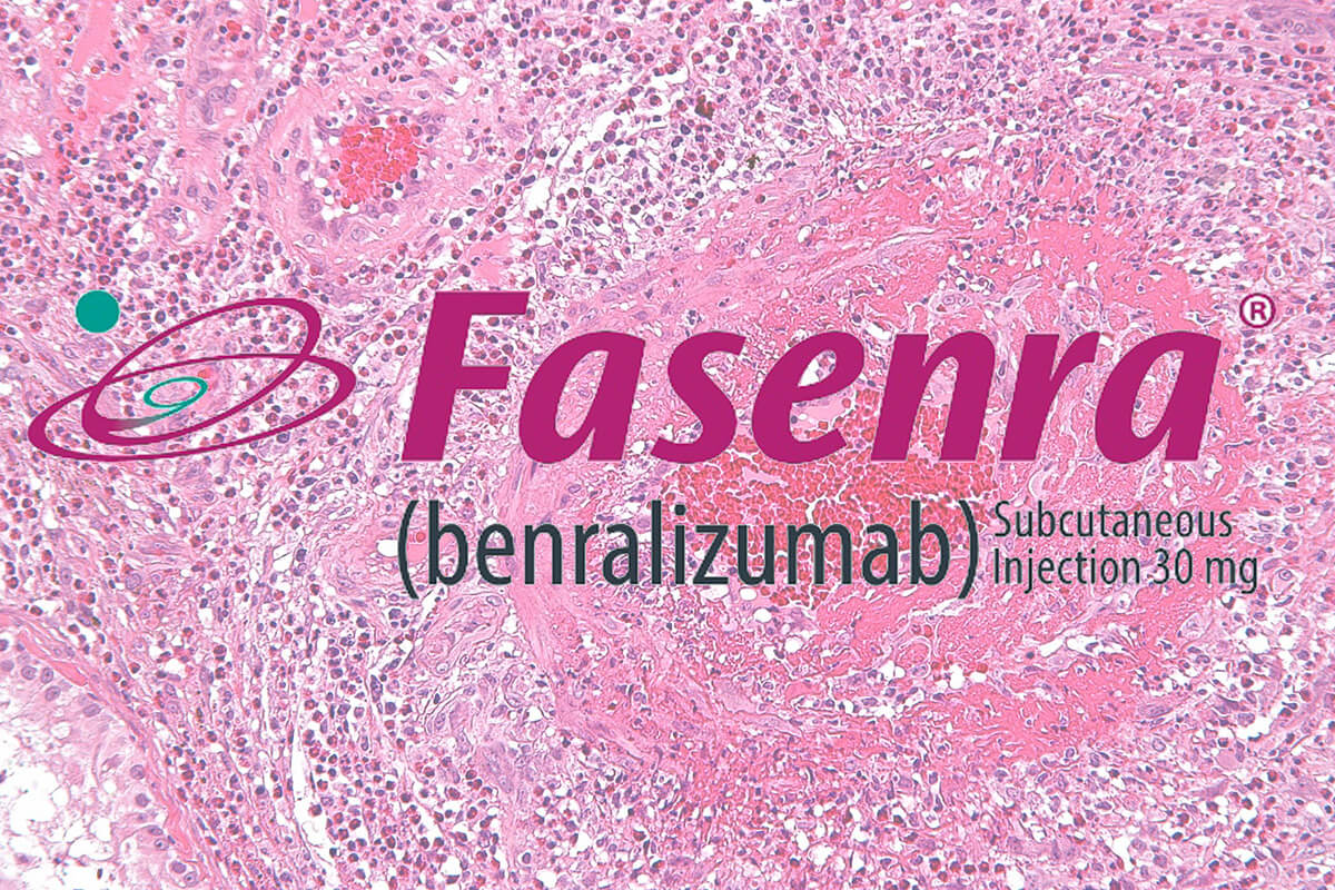 Fasenra on EGPA tissue background